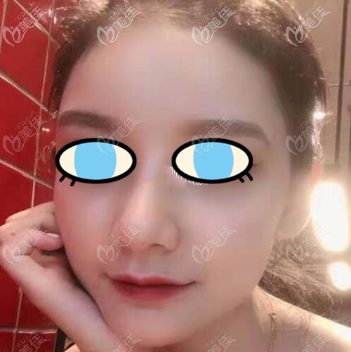 膨體隆鼻術(shù)后三個月效果 膨體隆鼻術(shù)后三個月效果