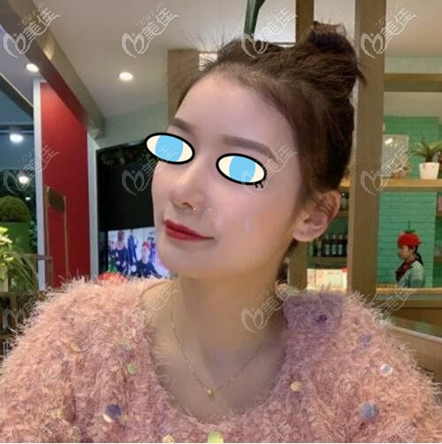 南寧夢想膨體隆鼻后期效果:術(shù)前的鼻梁塌陷不見了,只留下挺翹立體