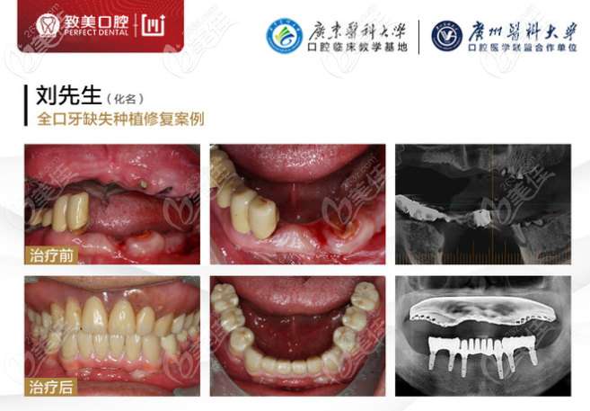 惠州致美口腔醫(yī)院全口種植牙<span style=