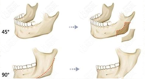 <!--<i data=20240703-sp></i>-->下頜角手術(shù)哪家好？參考<!--<i data=20240703-sp></i>-->下頜角磨骨人氣醫(yī)生技術(shù)