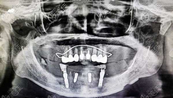 60多歲老人牙齒缺失情況圖 60多歲老人牙齒缺失情況圖
