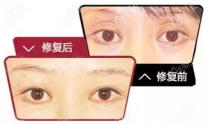 自體脂肪填充眼窩真人案例圖片 自體脂肪填充眼窩真人案例圖片