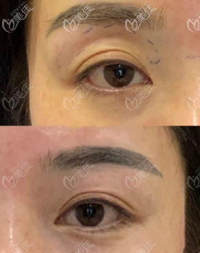 自體脂肪豐眼窩真人照片效果 自體脂肪豐眼窩真人照片效果