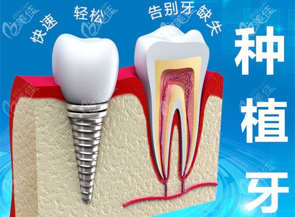 種植體和牙冠的模型圖 種植體和牙冠的模型圖