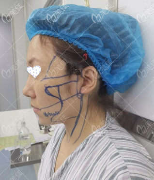 術前側(cè)面照片 術前側(cè)面照片