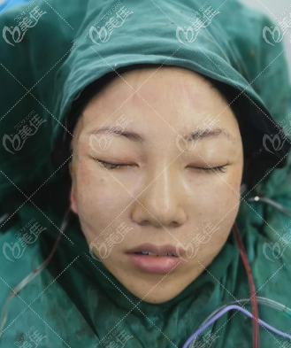 韓國Liting整形外科中下面部小拉皮提升手術即刻照片 韓國Liting整形外科中下面部小拉皮提升手術即刻照片