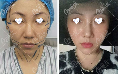 韓國醫(yī)生李成俊面部mini拉皮除皺手術(shù)恢復照片，花費8萬