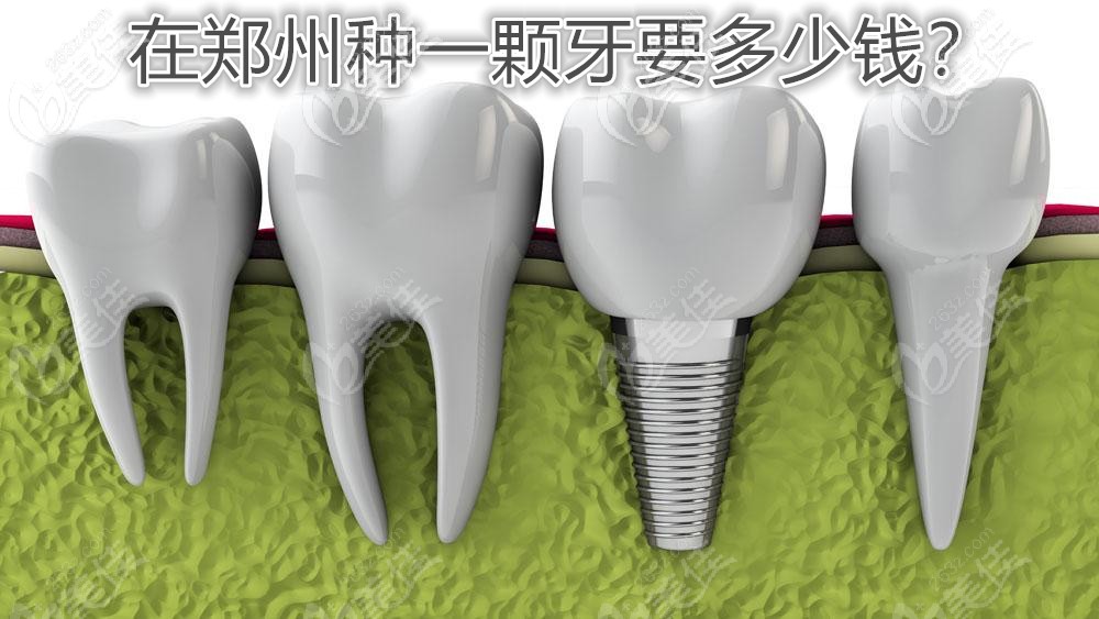 2021年在鄭州做種植牙價格表已更新,單顆和半口種牙費用都很親民