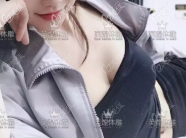 做自體脂肪豐胸2個多月的樣子