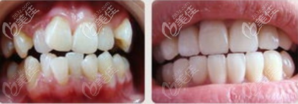 矯正案例--牙列擁擠