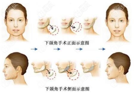 沈陽(yáng)杏林做下頜角削骨手術(shù)怎么樣