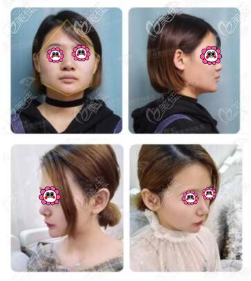 沈陽(yáng)杏林朱石江下頜長(zhǎng)曲線截骨術(shù)真人前后對(duì)比照