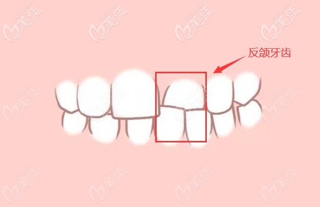 個(gè)別牙齒反頜癥狀圖片 個(gè)別牙齒反頜癥狀圖片