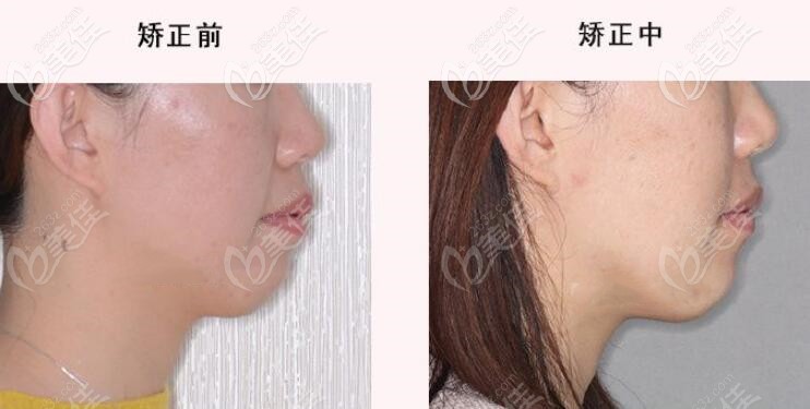 舌側(cè)矯正前和矯正中對(duì)比圖 舌側(cè)矯正前和矯正中對(duì)比圖