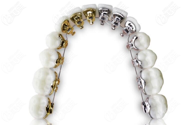 舌側(cè)矯正示例圖 舌側(cè)矯正示例圖