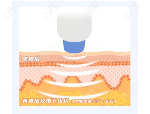 熱瑪吉治療面部下垂的原理 熱瑪吉治療面部下垂的原理