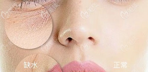 皮膚缺水出現(xiàn)干紋
