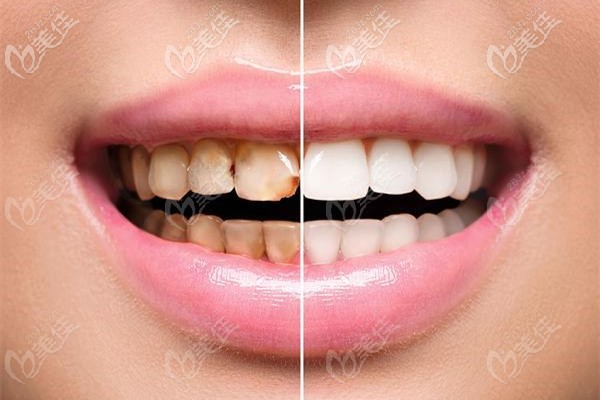 牙齒美白的前后效果