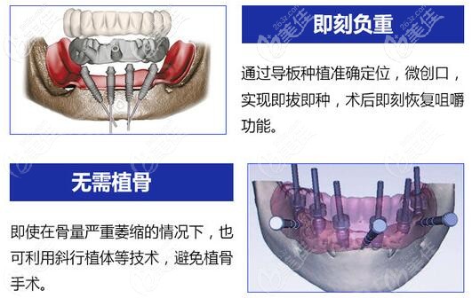 ALL-ON-4種植技術(shù)無(wú)需植骨粉