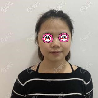 做鼻綜合術(shù)前照 做鼻綜合術(shù)前照