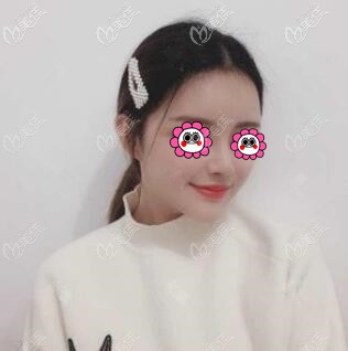 鼻綜合整形術(shù)后15天效果照 鼻綜合整形術(shù)后15天效果照