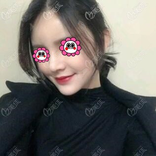 在大連星妍做鼻綜合整形術(shù)后57天恢復過程記錄，鼻梁用的是進口韓士生科假體！