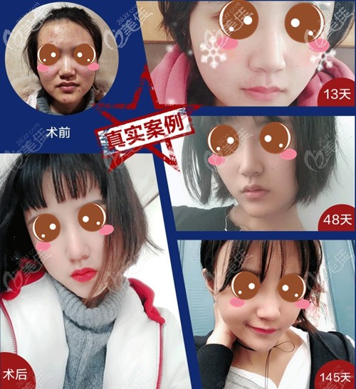 武漢美基元射極峰膨體鼻修復(fù)案例 武漢美基元射極峰膨體鼻修復(fù)案例