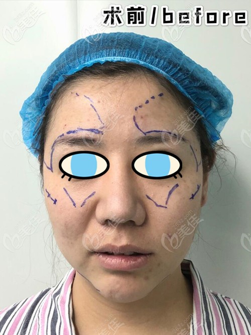 術(shù)前照片 術(shù)前照片