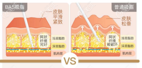 醫(yī)院吸脂優(yōu)勢(shì)