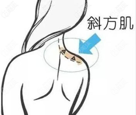 背部吸脂包括斜方肌 背部吸脂包括斜方肌