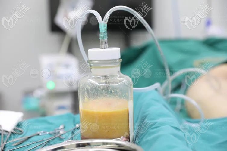 醫(yī)生吸脂經(jīng)驗(yàn)不足導(dǎo)致出血多