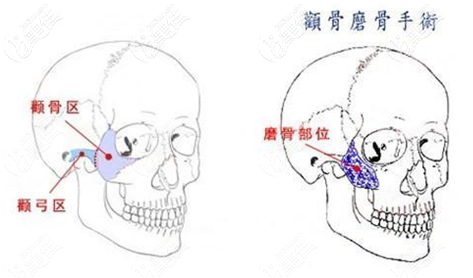 磨顴骨示意圖 磨顴骨示意圖