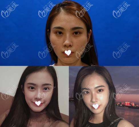 顴骨內(nèi)推7mm效果圖 顴骨內(nèi)推7mm效果圖