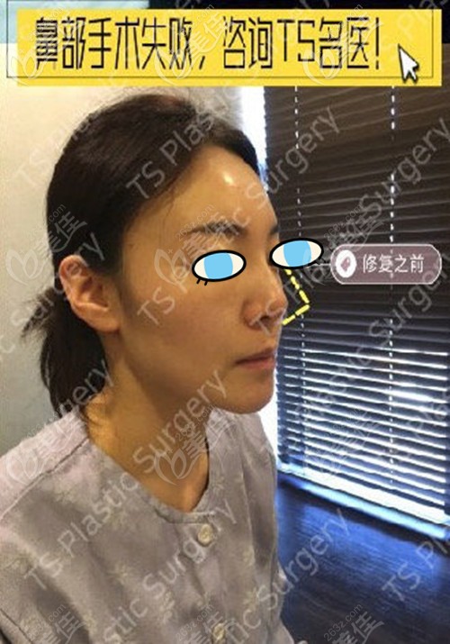 鼻修復術前照片