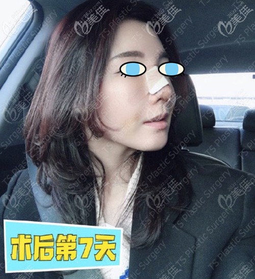 鼻修復術后一周效果