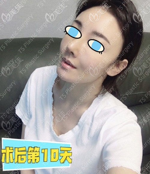 鼻修復術后十天效果