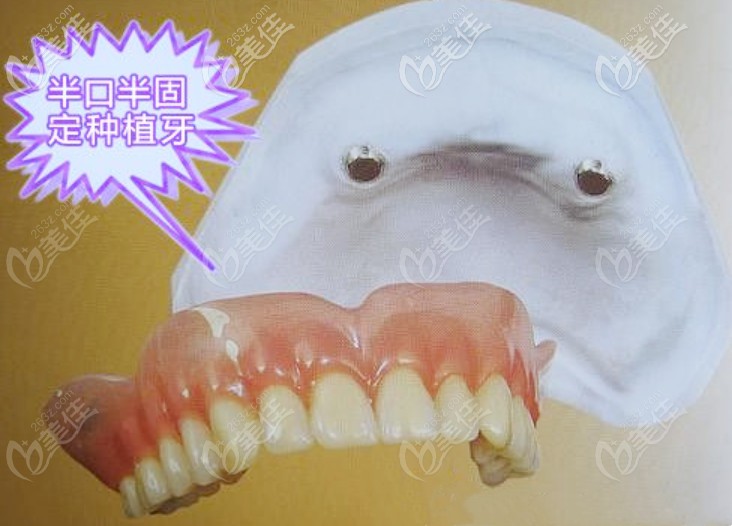 半口半固定種植牙
