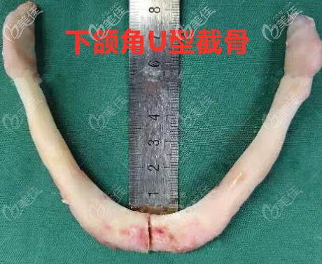 下頜U型截骨術(shù)