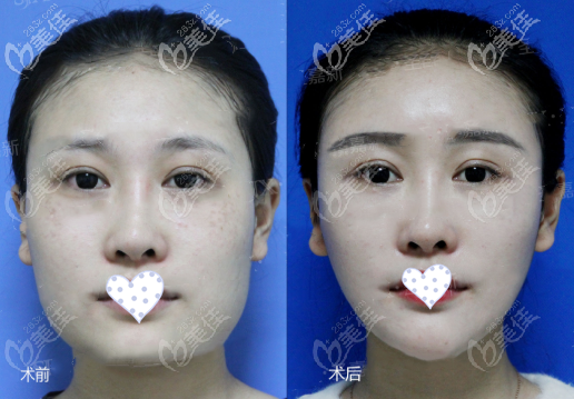 下頜角長(zhǎng)曲線截骨正面效果圖對(duì)比