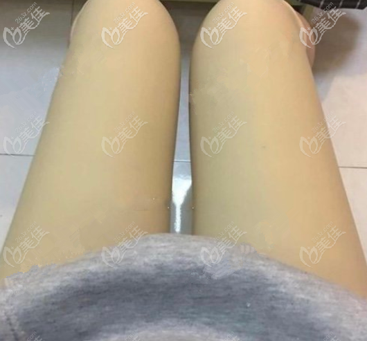 <!--<i data=20240703-sp></i>-->給我做大腿抽脂第3天