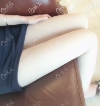 做完腿部吸脂有半個多月了