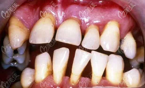 牙根外漏的實(shí)拍圖