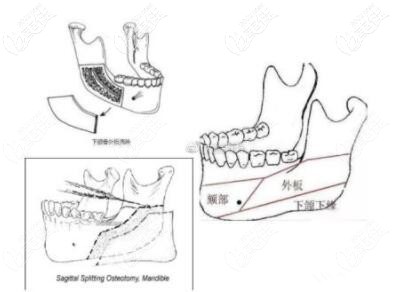 需要單純做下頜角劈外板的情況