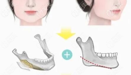 需要做下頜角截骨+外板劈除的情況