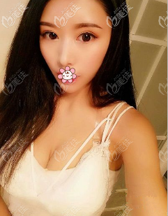 重慶美萊曼托275cc隆胸6個(gè)月照片 重慶美萊曼托275cc隆胸6個(gè)月照片