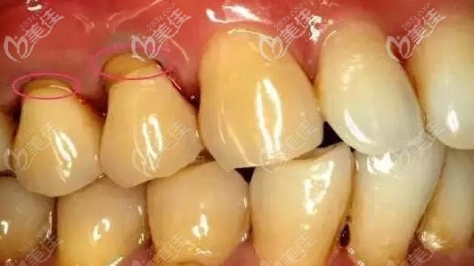 楔狀缺損外觀示意圖