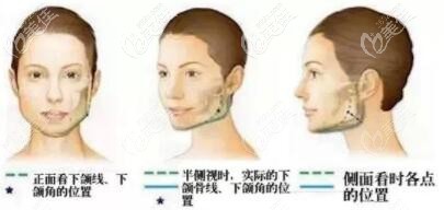 做完下頜角手術(shù)后臉還是很寬