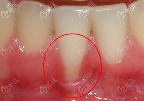 牙根暴露的示意圖