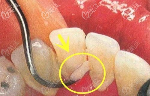 牙結(jié)石過多導(dǎo)致牙齦萎縮