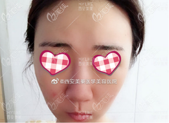 西安美萊做鼻子的術(shù)前案例圖 西安美萊做鼻子的術(shù)前案例圖